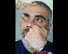 Szem vakarás