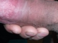 lompos