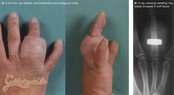 Az elveszett jeggyűrű