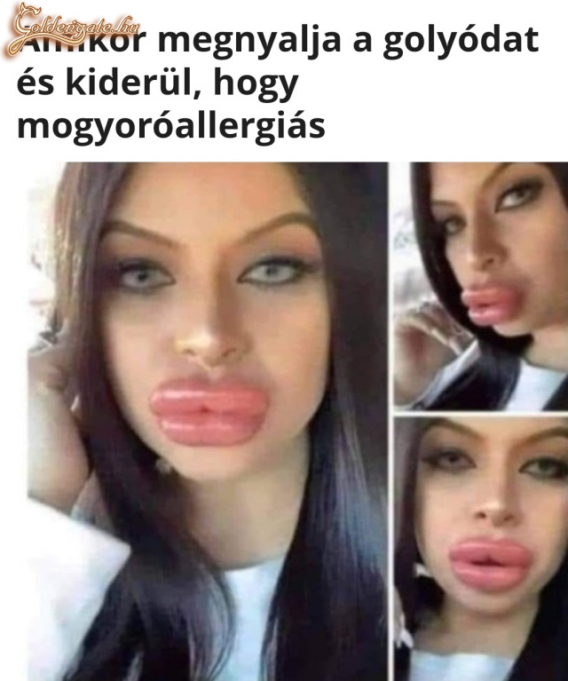 Mogyoróallergia