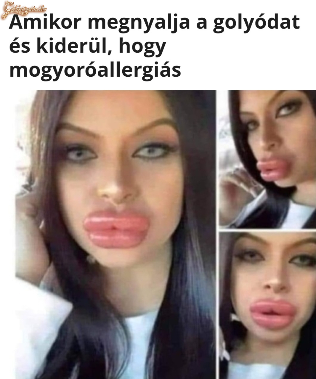 Mogyoróallergia