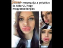 Mogyoróallergia